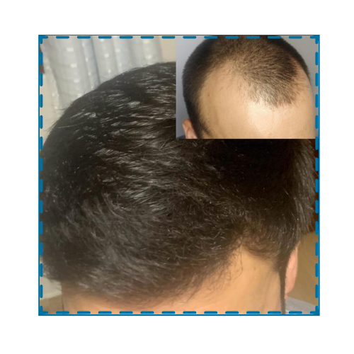 Transplante Feminino